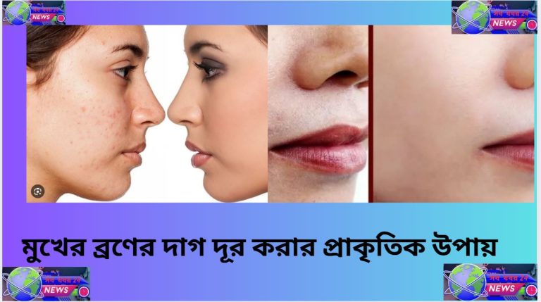 মুখের ব্রণের দাগ নিরাময়ে সহজ পথ