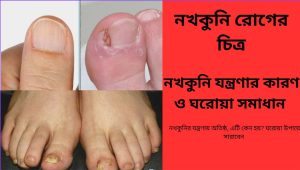 নখকুনি আক্রান্ত নখ ও প্রদাহিত কোণ