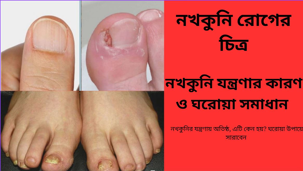 নখকুনি আক্রান্ত নখ ও প্রদাহিত কোণ